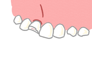破折歯